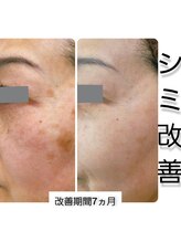 エヌミー(N me)/シミ改善結果