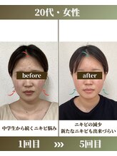 けいのき鍼灸整骨院/美容鍼1ヵ月5回の効果！美容鍼灸