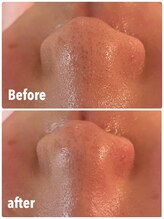 シャインクラフト/毛穴ケア