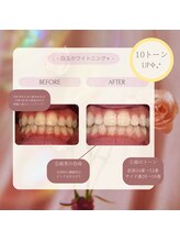 プラスビー 2号店(+b)/ホワイトニングビフォーアフター