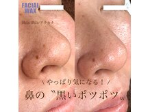 フェイシャルwaxは産毛と角質を同時にケアするお肌の土台づくり