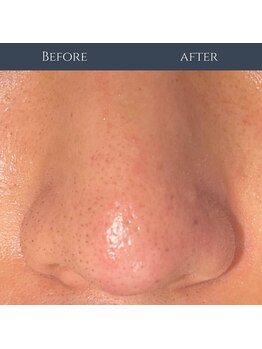 ビナリ 東銀座(BINARI)の写真/毛穴汚れやくすみを徹底ケア。眉毛スタイリングやホワイトニングもあわせて第一印象を一気に整える☆