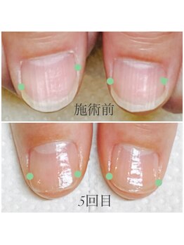 ネイルサロン アルファガーデン 町田本店(α garden)/最強のネイルケア　症例写真