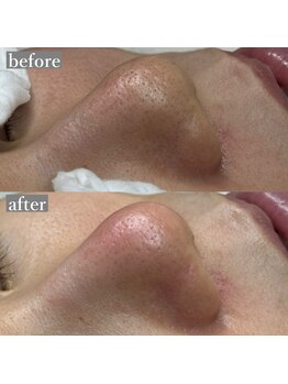 ライカブルー(RaicA BluE)/施術写真