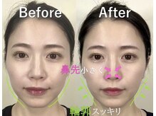 ラプリ 横浜店(Raplit)/隆鼻＋輪郭矯正40分