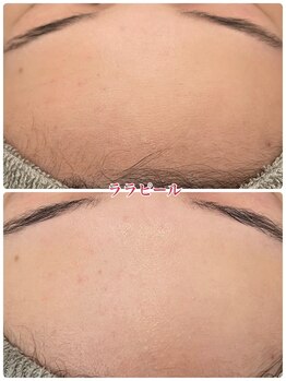 トリアングル(TLIENGLE)/エクソソームハーブbeforeafter