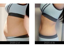 ボディアーキ 高知大丸店(BODY ARCHI)/お腹のbefore・after（横）