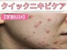 【学割U24】スピードニキビケア＋クイックマッサージ付き(60分)¥8,800→3,990