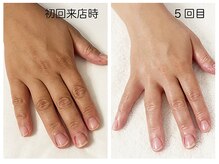 キレイテ 福岡天神店/40代/5回目【天神ハンドケア】