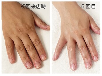 キレイテ 福岡天神店/40代/5回目【天神ハンドケア】