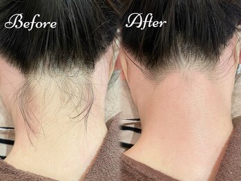 ピミル(PIMIL)/うなじ脱毛