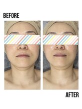 イードット(E.)/BBLで顎ラインもシャープに！！