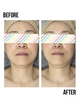 イードット(E.)/BBLで顎ラインもシャープに!!