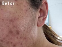 オアシスラグーン(OASIS LAGOON)/ニキビケア（症例３：before）