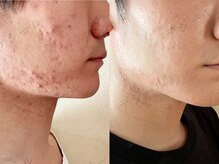 デジール/メンズ毛穴洗浄吸引ニキビケア