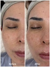 ミスキー 長野駅前店(misky)/艶肌フェイシャルワックス