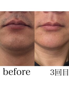 ラブ アンド ピース(Love&Peace)/髭脱毛3回目