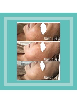 エフエフディースキンケア(FFD SKINCARE)/エイジング/シミ/リフトアップ