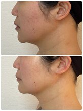 ルミア(LUMIA)/小顔造形ロイヤル