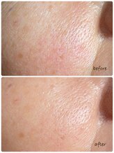 アデージョ(Adejio)/ララピール　60代お客様