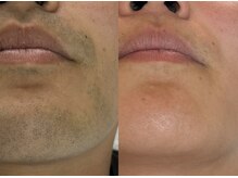 フェリス(FELIZ)/美肌で印象が変わるヒゲ脱毛