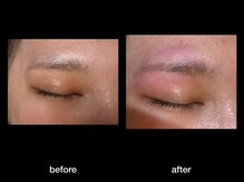 トゥルース(Truth)/美容電気脱毛で終わりある脱毛