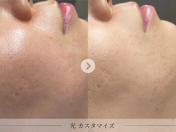 スパレーカ(Spa laka)/毛穴・凹凸ケア