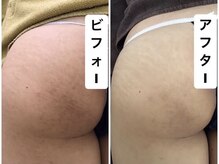 アーニャビューティー(Anya Beauty)/お尻のハーブピーリング