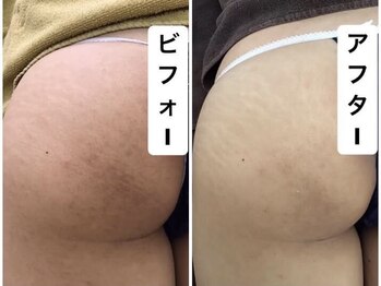 アーニャビューティー(Anya Beauty)/お尻のハーブピーリング