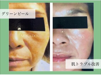 ミカド(MIKADO)/エイジングにハーブピーリング