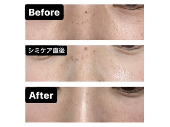 エフ(f)/シミケアとしわ、たるみ毛穴ケア