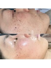 サロンディア(SALON Dea)/4ヶ月施術効果