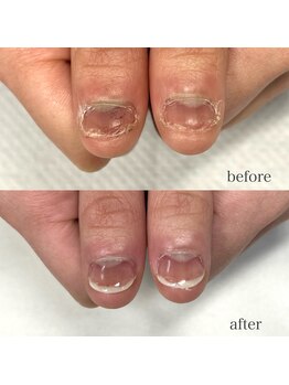 エムアンド(M and)/深爪矯正再生コース