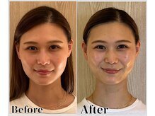 整体ラルース 中目黒(LALUZ)/20代 女性 頭蓋骨小顔矯正　変化
