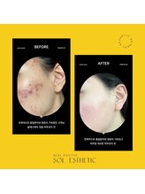 プランス 渋谷(PLANCE)/韓国/肌管理/ニキビケア/毛穴