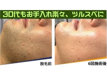 ジェントル 三宮/都度払い専門メンズ脱毛サロン