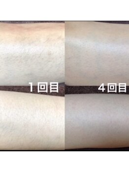 レヴール(reveur)/足脱毛[美容脱毛/新潟脱毛]