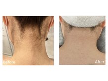 リッカ 学芸大学(RIKKA)/うなじ脱毛