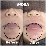 エムディーエスエー(MDSA)