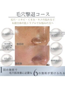 毛穴研究所/黒ずみニキビくすみ肌質の悩みに