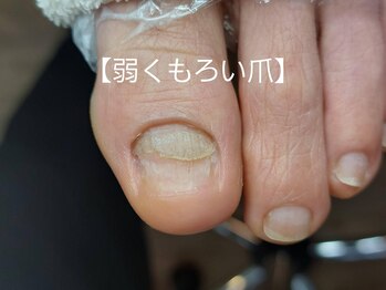 爪切り屋 足楽/爪が浮いて剥がれそうな方へ