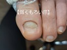 爪が浮いて剥がれそうな方へ