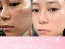 ファニービー 茨木店/20代 ニキビ 3ヶ月で改善