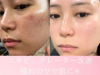 ファニービー 茨木店/20代 ニキビ 3ヶ月で改善