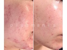 クレバイエヌアイビュティー(cle' by N eye beauty)の雰囲気（【ニキビケア】浜松でプラズマ×REVIハーブができるのは当店のみ）