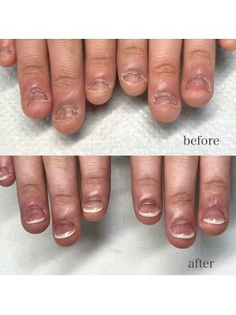 エムアンド(M and)/深爪矯正再生コース