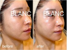 サロン ド ブラン アオヤマ(Salon de BLANC AOYAMA)/クリスティーナ美白