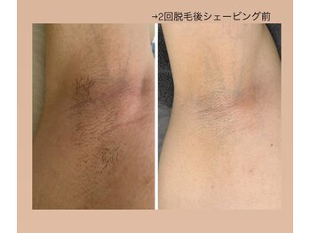 エヌ(enu)/脱毛/ワキ/フェイシャル