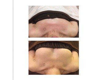 美人バスト 本厚木店/バストアップ◇症例◇