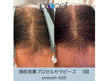 スムース626(smooth 626)の雰囲気（【育毛促進】感動レベル！大人気！頭皮改善プロセルセラピーズ）